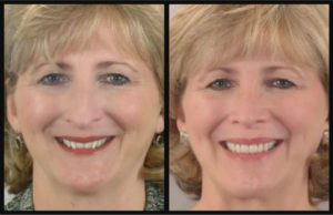 Woman reverse aging with orthodontics before and after